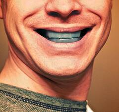 Teeth whitening